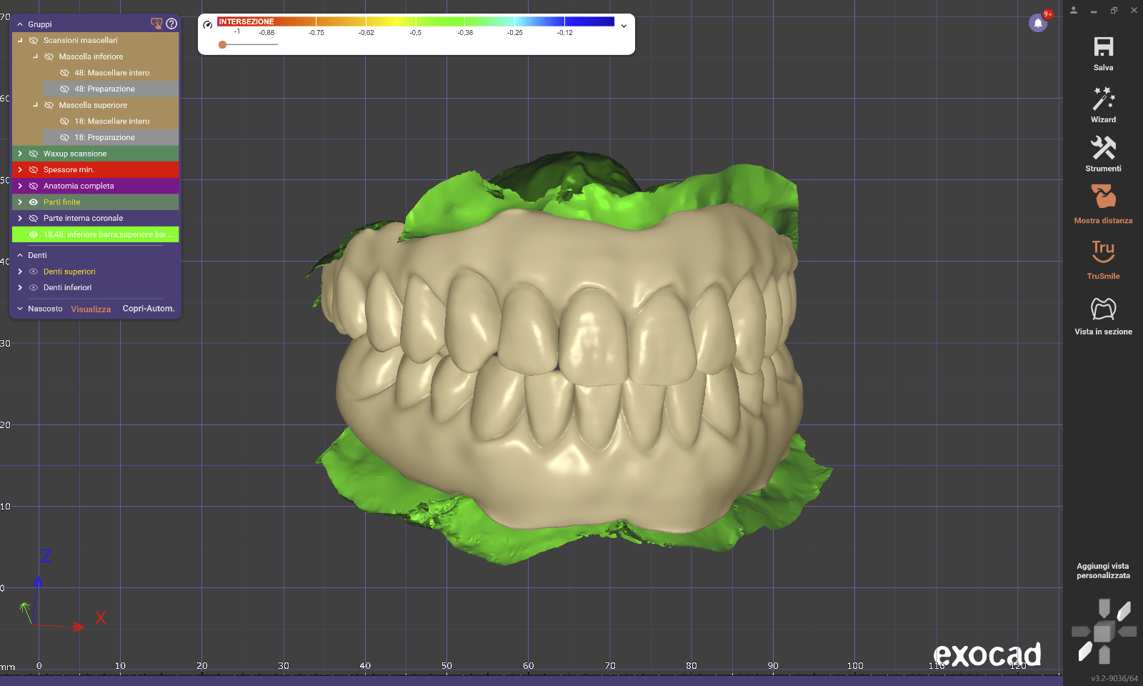 Digital Wax Up